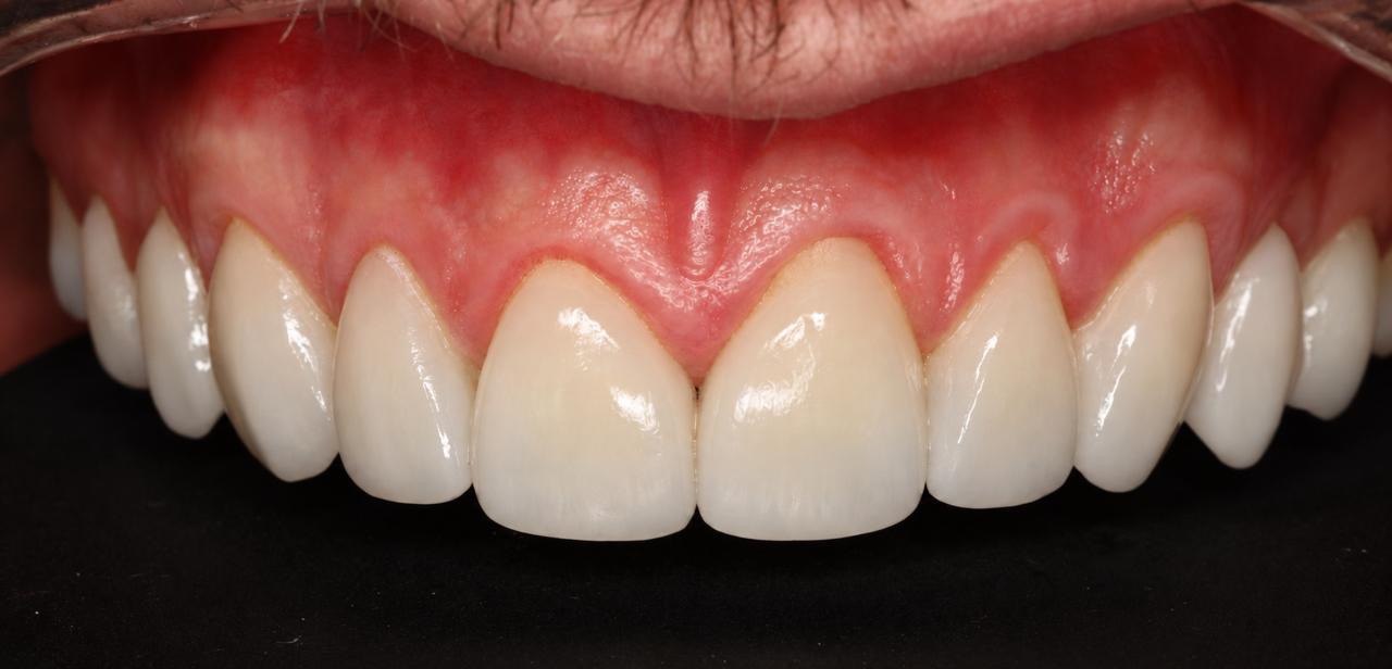 After: full upper arch no-prep veneers result