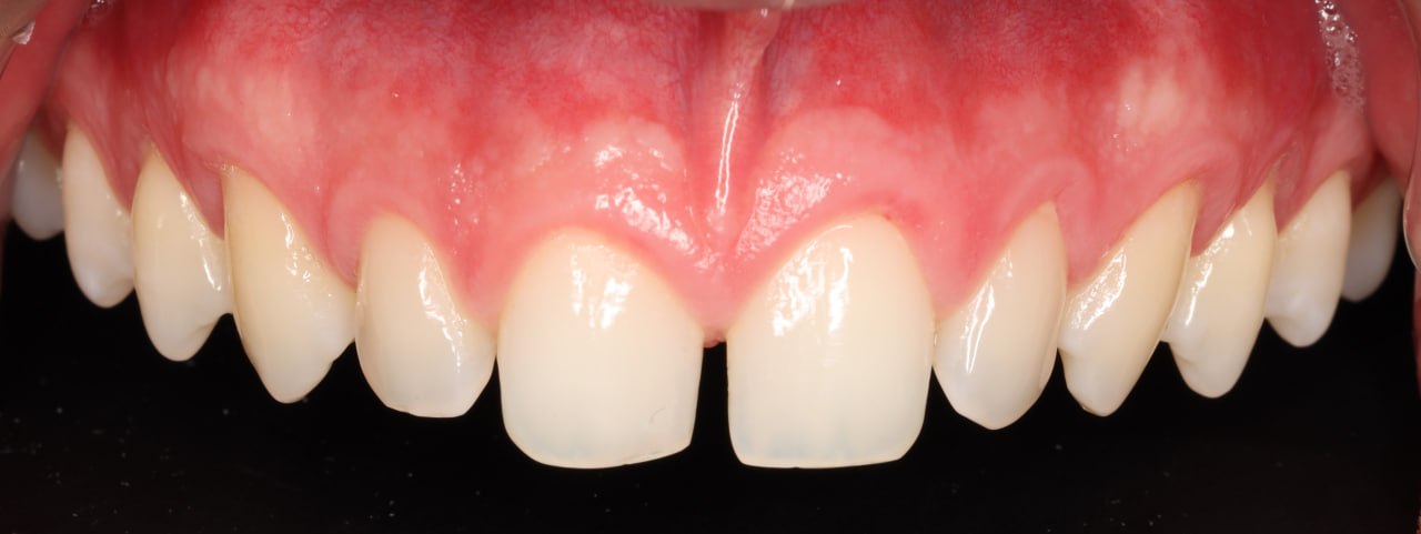 Before: natural teeth prior to no-prep veneer placement